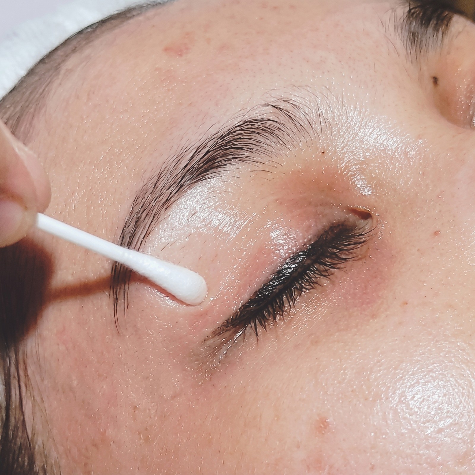 Non-surgical thread lift at COSMALIFE SKIN CLINIC